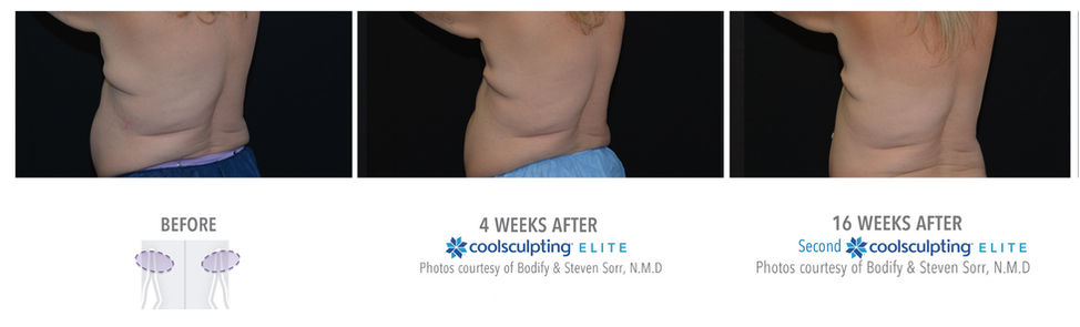 bra line coolsculpting results