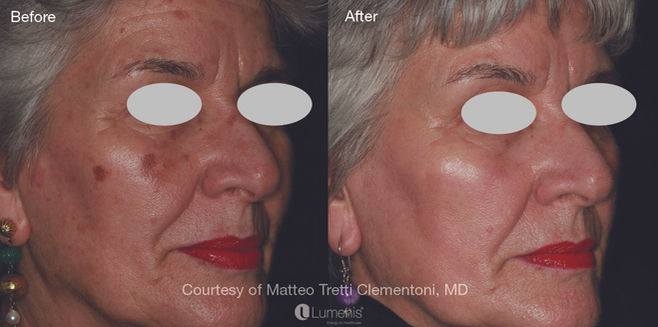 laser treatment before and after results