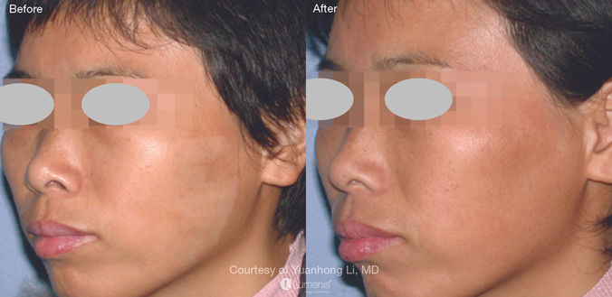 laser treatment before and after results