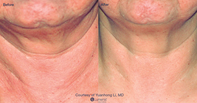 laser treatment before and after results