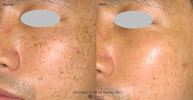 laser treatment before and after results