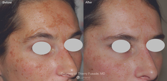 laser treatment before and after results