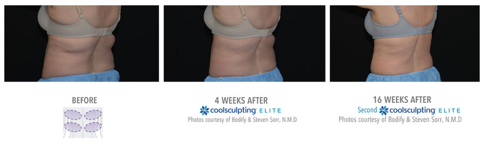 bra line coolsculpting results