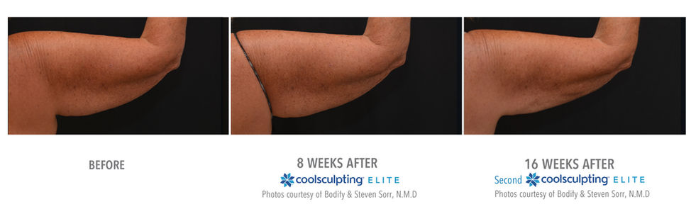 coolsculpting results upper arms