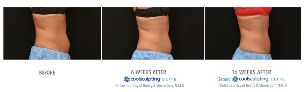 lower abs coolsculpting elite results