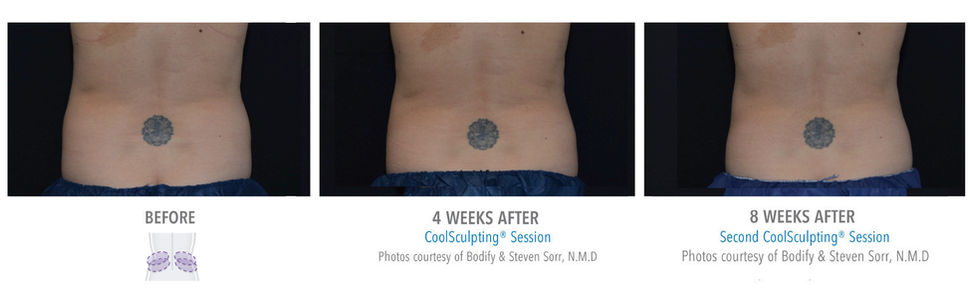 love handles coolsculpting before and after