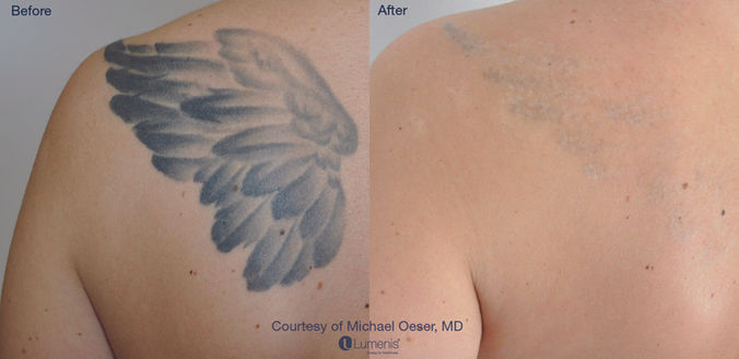 laser treatment before and after results