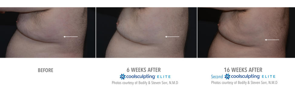 coolsculpting pecs before and after 