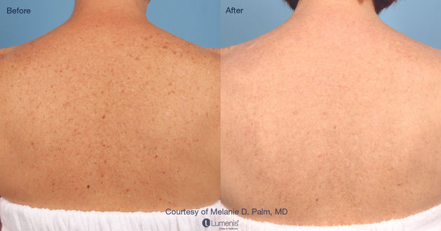 laser treatment before and after results