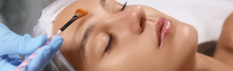 Chemical peel photo