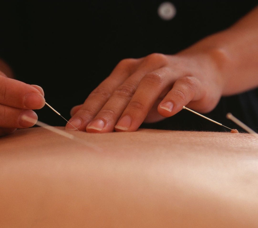 acupuncture