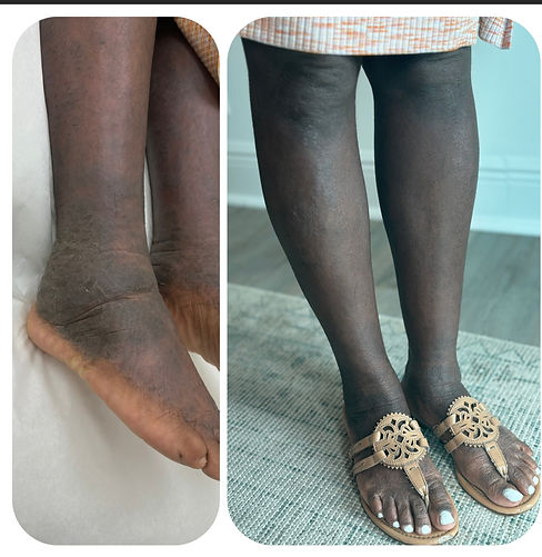 healing eczema