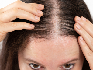 Proč mi padají vlasy