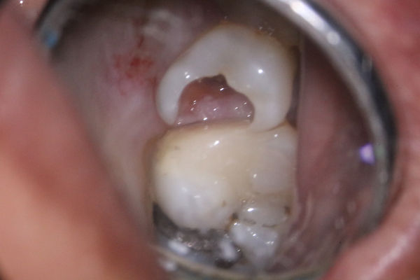 001 gingivectomy 01.JPG