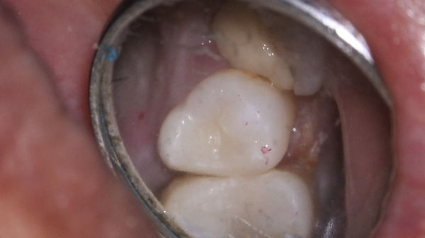 001 gingivectomy 05.JPG