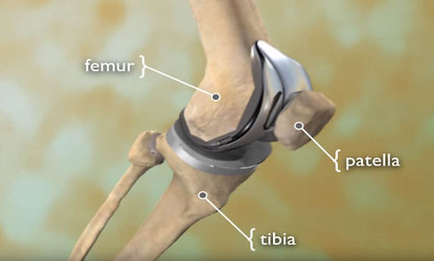 total-knee-replacement.jpg