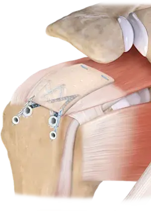 Shoulder.webp
