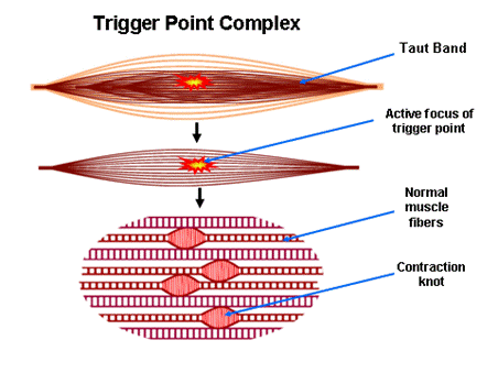 Trigger Point Release Physiotherapy in Edmonton