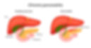 Pancreatitis Dr Purnendu Roy.jpg