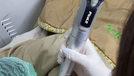Rahasia Kulit Cerah Merata: Mengapa PICO Laser Jadi Pilihan Utama untuk Body Brightening
