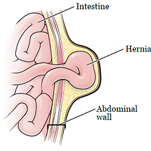 hernia_surgery-fig_2-en.png
