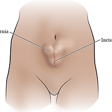 hernia_surgery-fig_1-en.png