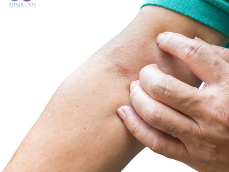 Dermatite atópica: como funciona a ozonioterapia para doenças de pele