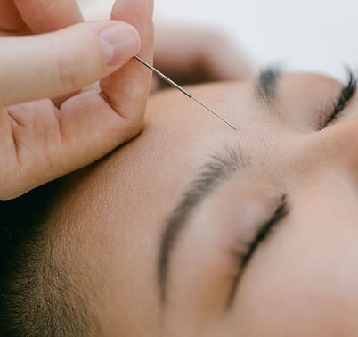 facial cosmetic acupuncture rejuvenation glow skin