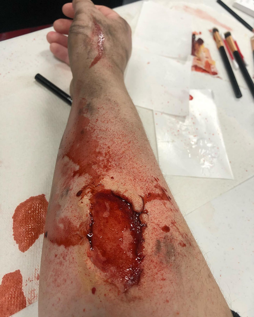 Wound
