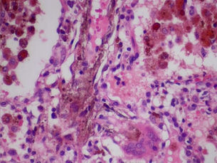 World Thrombosis Day 2024: History, importance, and tips to reduce the risk