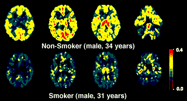 Smoking Effect on Brain 1.14.2016.gif