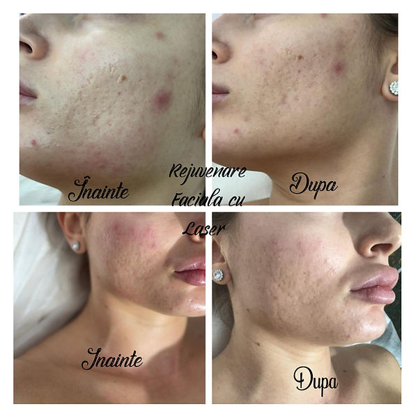 rejuvenare faciala cu laser rezultat