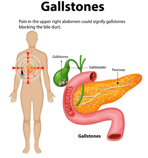 What Are Gallstones