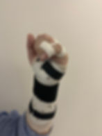 orthèse statique poignet syndactylie D4 D5 pour fracture 5ème métacarpien