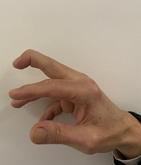 Mallet Finger