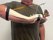 Témoignage : Orthèse dynamique d'extension de doigt pour Dupuytren