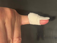 Témoignage : Orthèse pour mallet finger