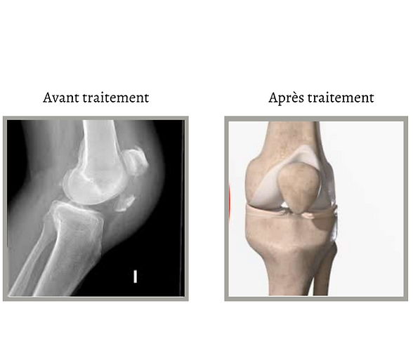 Tout savoir sur une fracture rotule ( avant et après traitement )