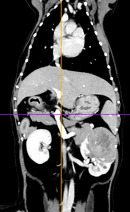 Dorsal CT scan of the abdomen of a dog showing a large renal tumour
