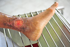 Chronic venous leg ulcer