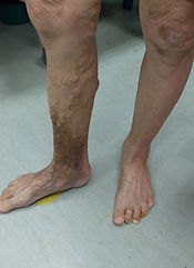 Varicose veins with venous hypertensive changes