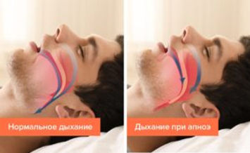 лечение храпа казань