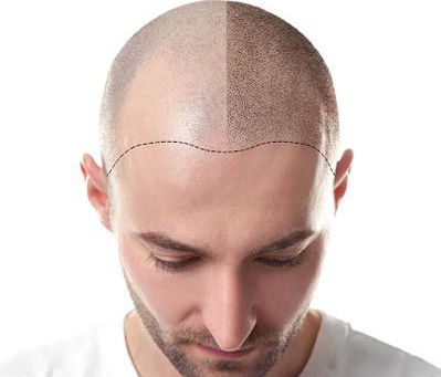Losing hair can feel like losing a part of yourself—your looks