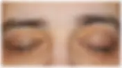 Xanthelasma Treatment