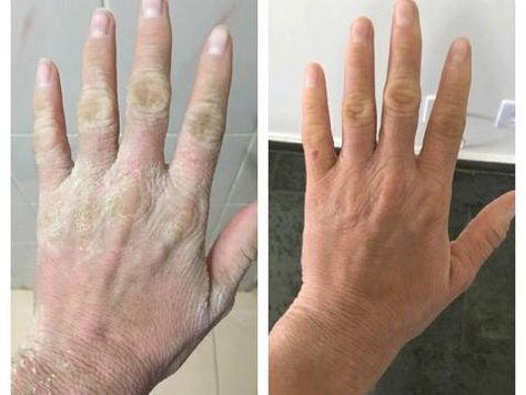Mariana Ferreira - Ichtyosis