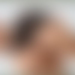CASPA E DESCAMAÇÃO? Saiba como Eliminar Caspa com Tratamento Natural Ayurvédico