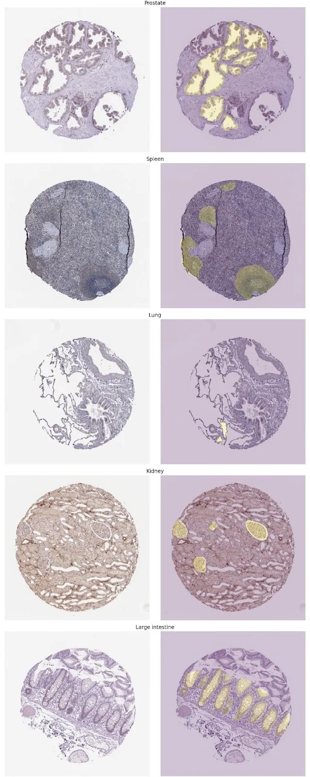 Left is the tissue sample image; the right is the same image with the highlighted FTUs