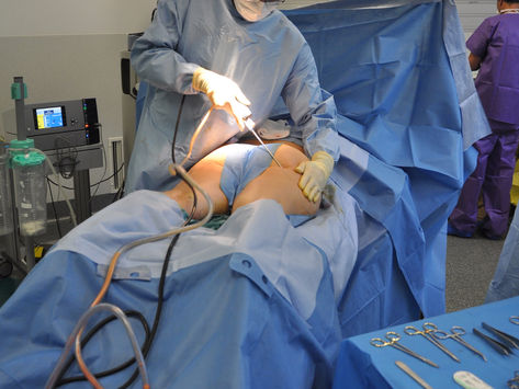 Facts to Know Before Going for Weight Loss Surgery