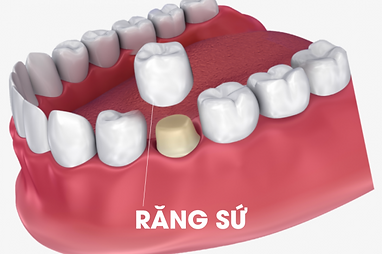 bọc răng sứ