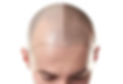 Scalp micropigmentation
